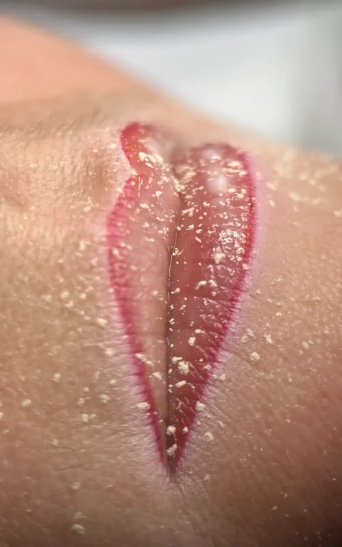 szájtetoválás előkészületek